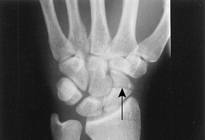 Tales of Wonder and Woe: UWOL X-scaphoid.jpg